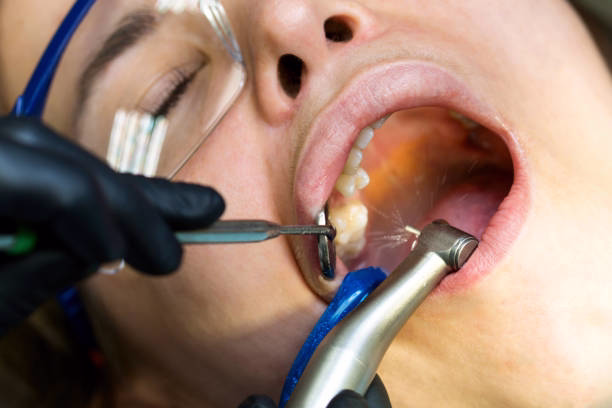 Root Canal Specialists at Ewing Dental Group in Ewing, NJ